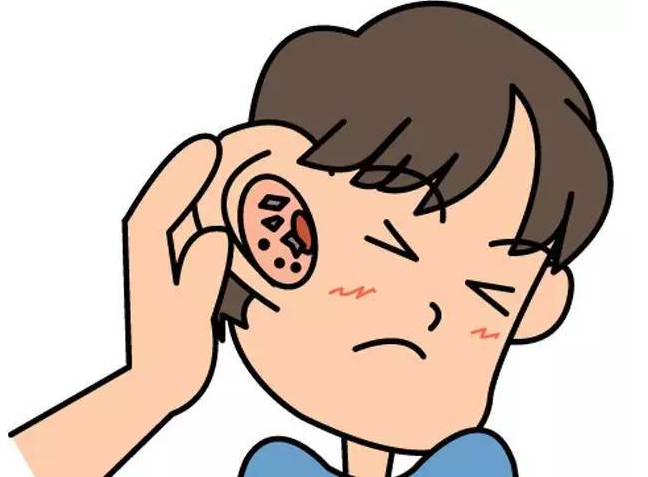 外耳炎如何预防